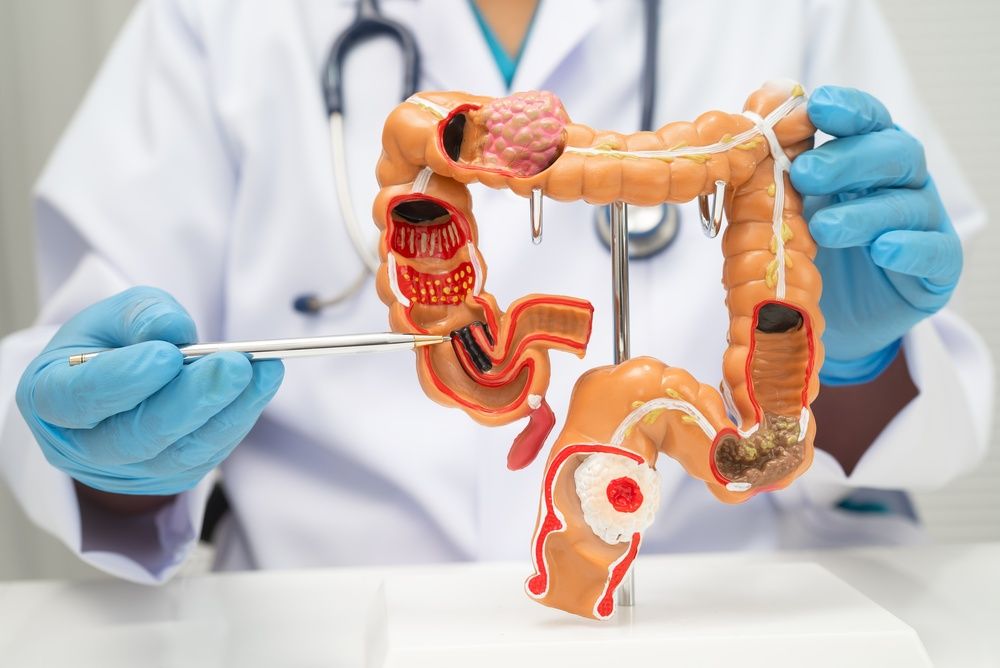 Cáncer de colon — Dr. Aldo Olvera Casas, Querétaro