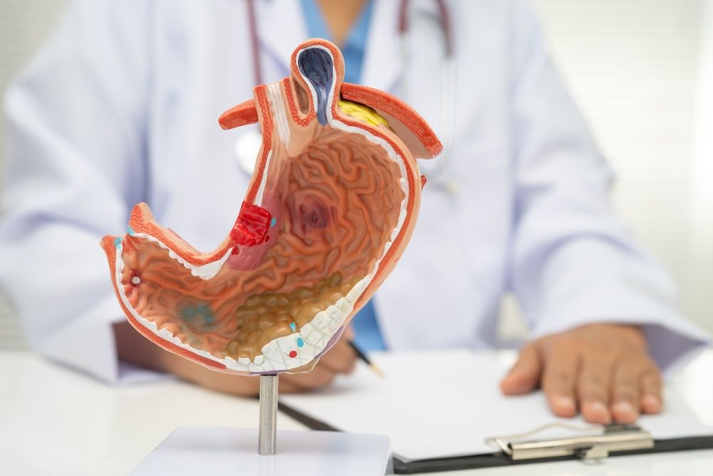 Tumores del tubo digestivo — Dr. Aldo Olvera Casas, Querétaro
